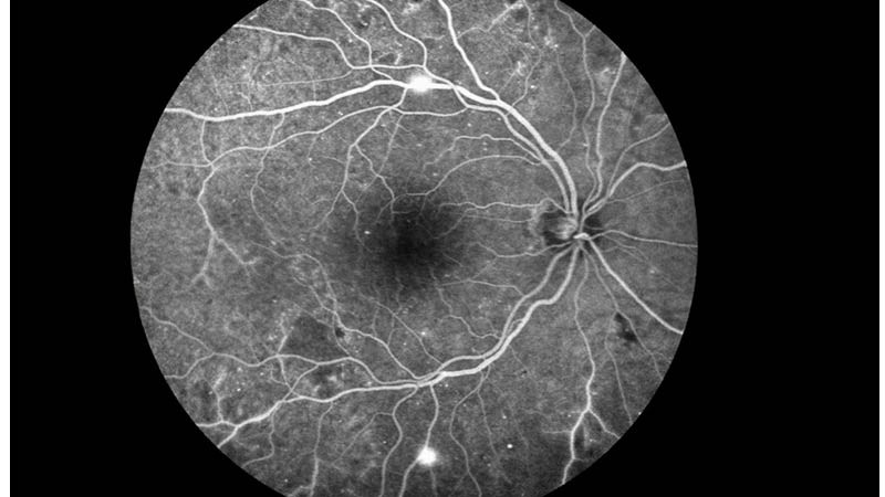 Diabetische Retinopathie 