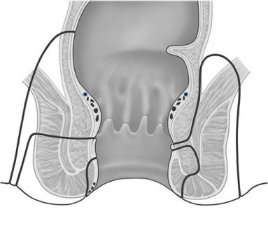fisteln516 fisteln516