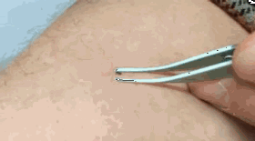 Eine blutsaugende Zecke wird von einem Unterarm entfernt. Als Werkzeug dient eine spitz zulaufenden Pinzette.