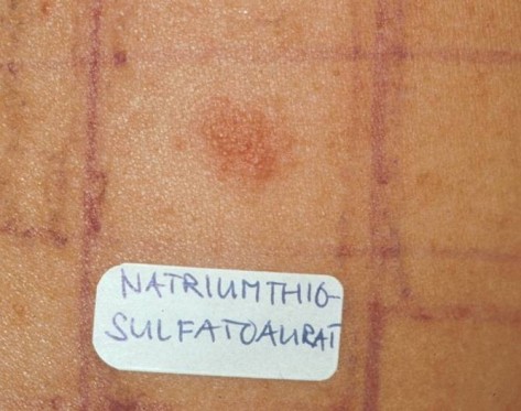 Reaktion auf Natriumthiosulfatoaurat