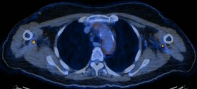 PET-CT Hybridbild liefert genauere Informationen über die Anreicherung des Radiopharmakons im Körper