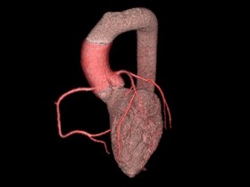 Darstellung der Herzkranzgefässe (CT-Koronarangiographie)
