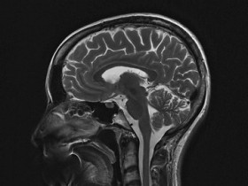 Querschnittsbild des Kopfes mit Darstellung des Gehirnes.                                                                                                           