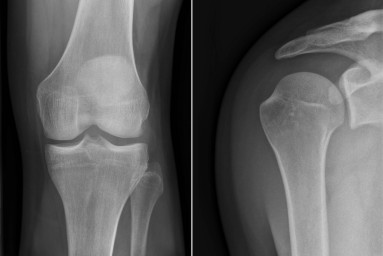 Bild links: Röntgenaufnahme Knie; rechts: Schulter