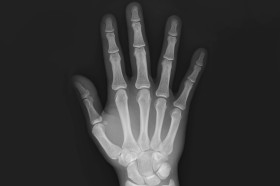 Röntgenaufnahme von flach aufliegender Hand