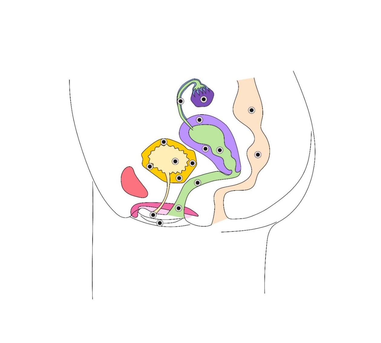 Illustration Endometriose